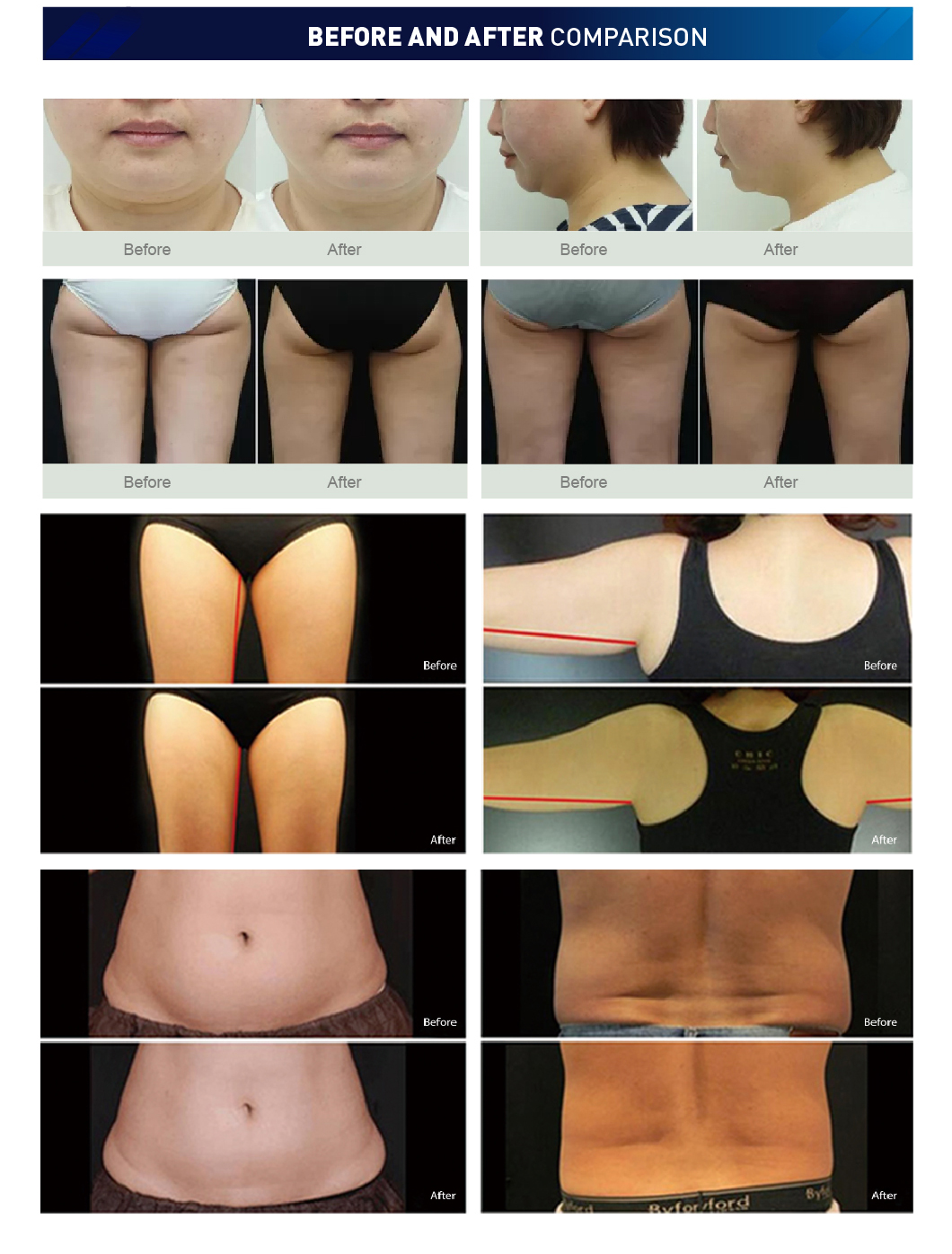 gasto sa cryolipolysis