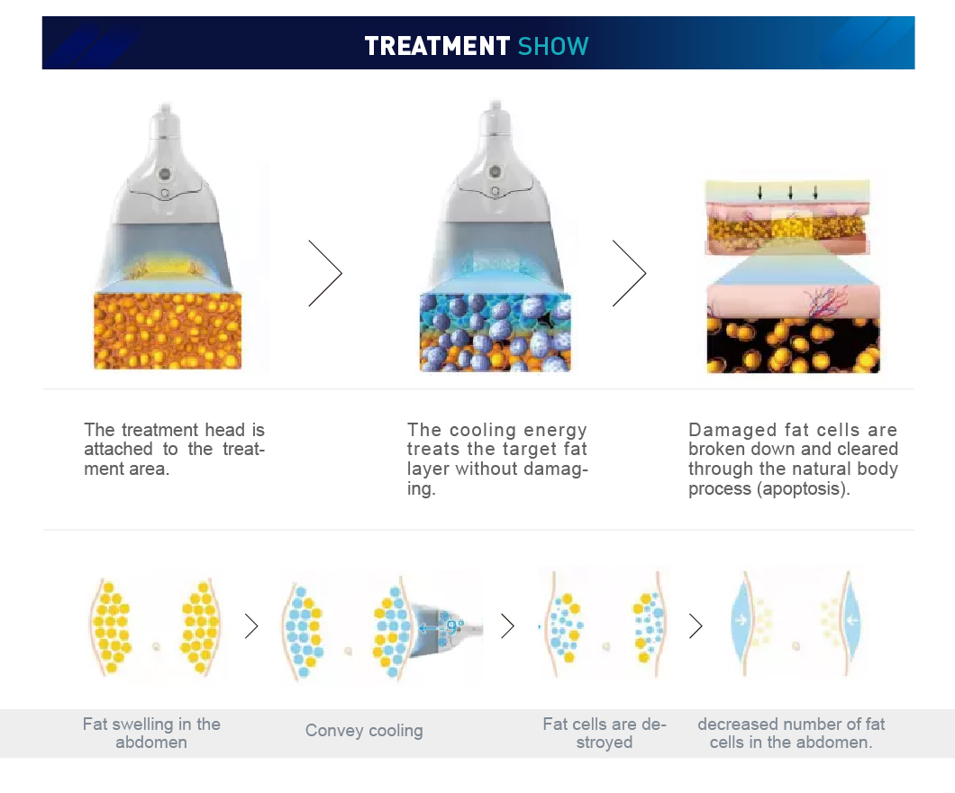 가정용 cryolipolysis 기계