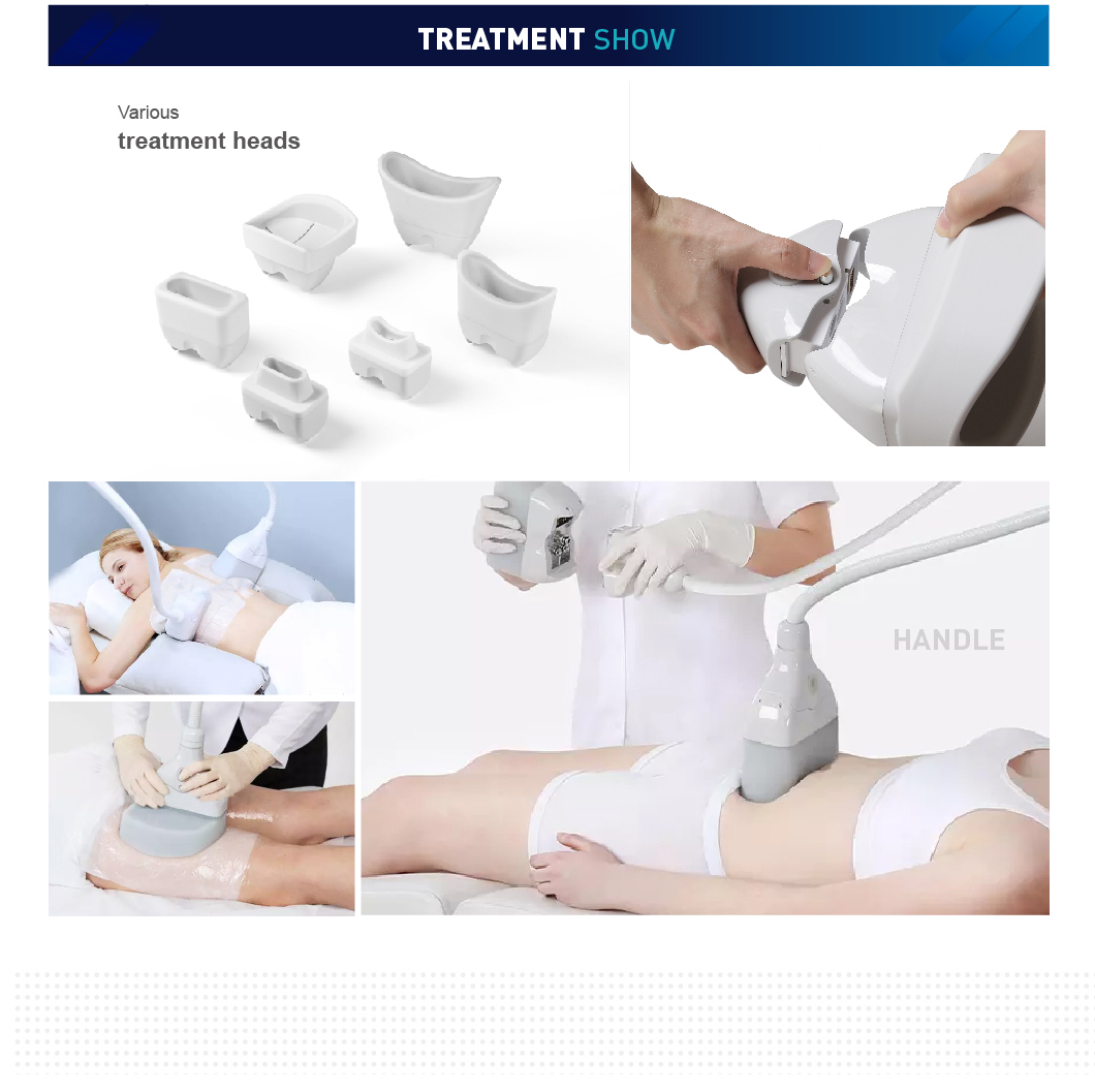 bei ya cryolipolysis