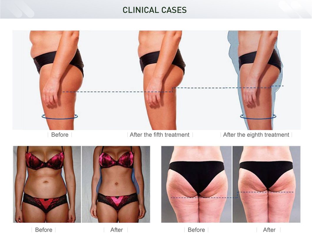 Estimulador muscular abdominal ems