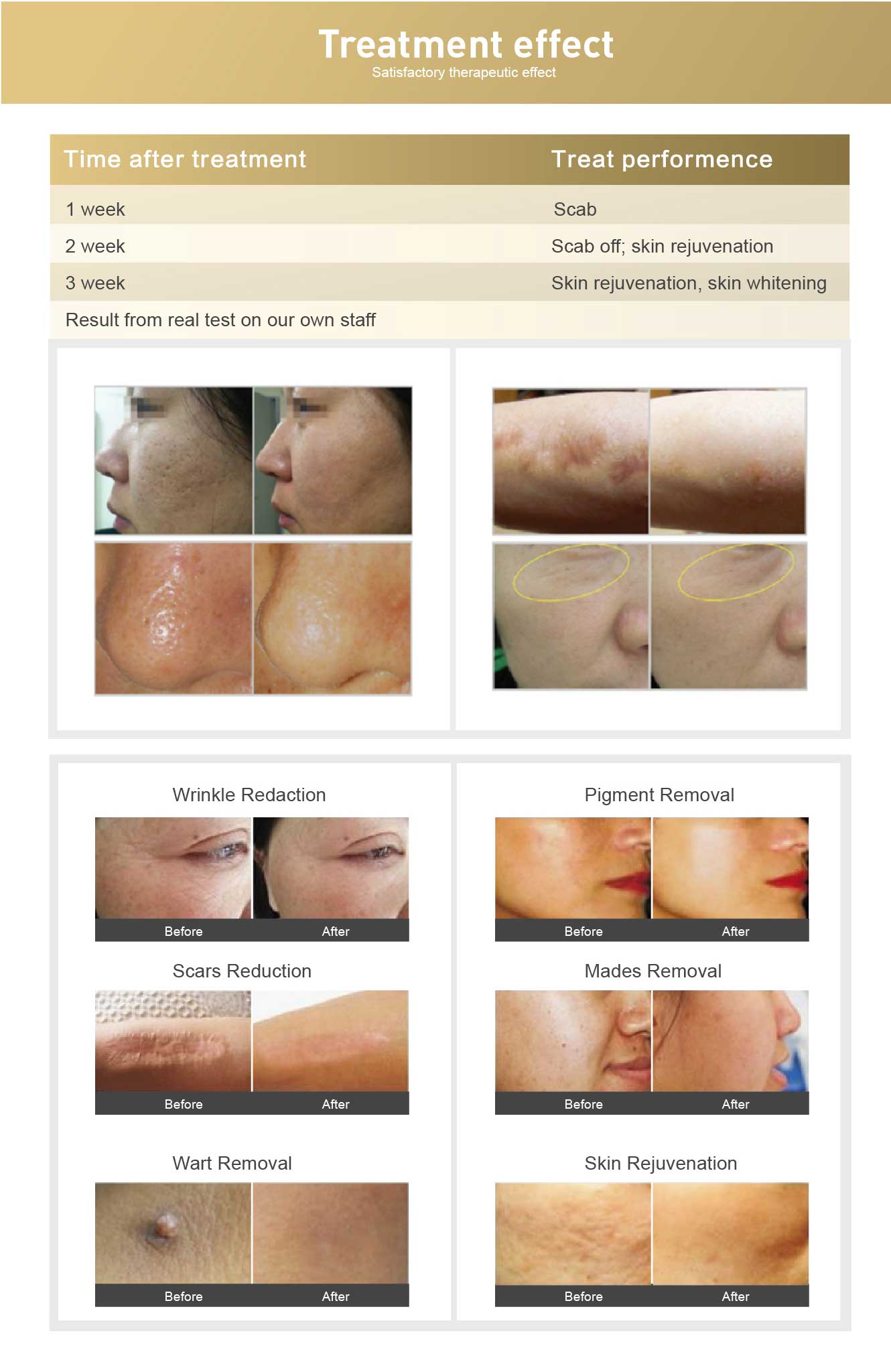 CO2 fractional laser treatment