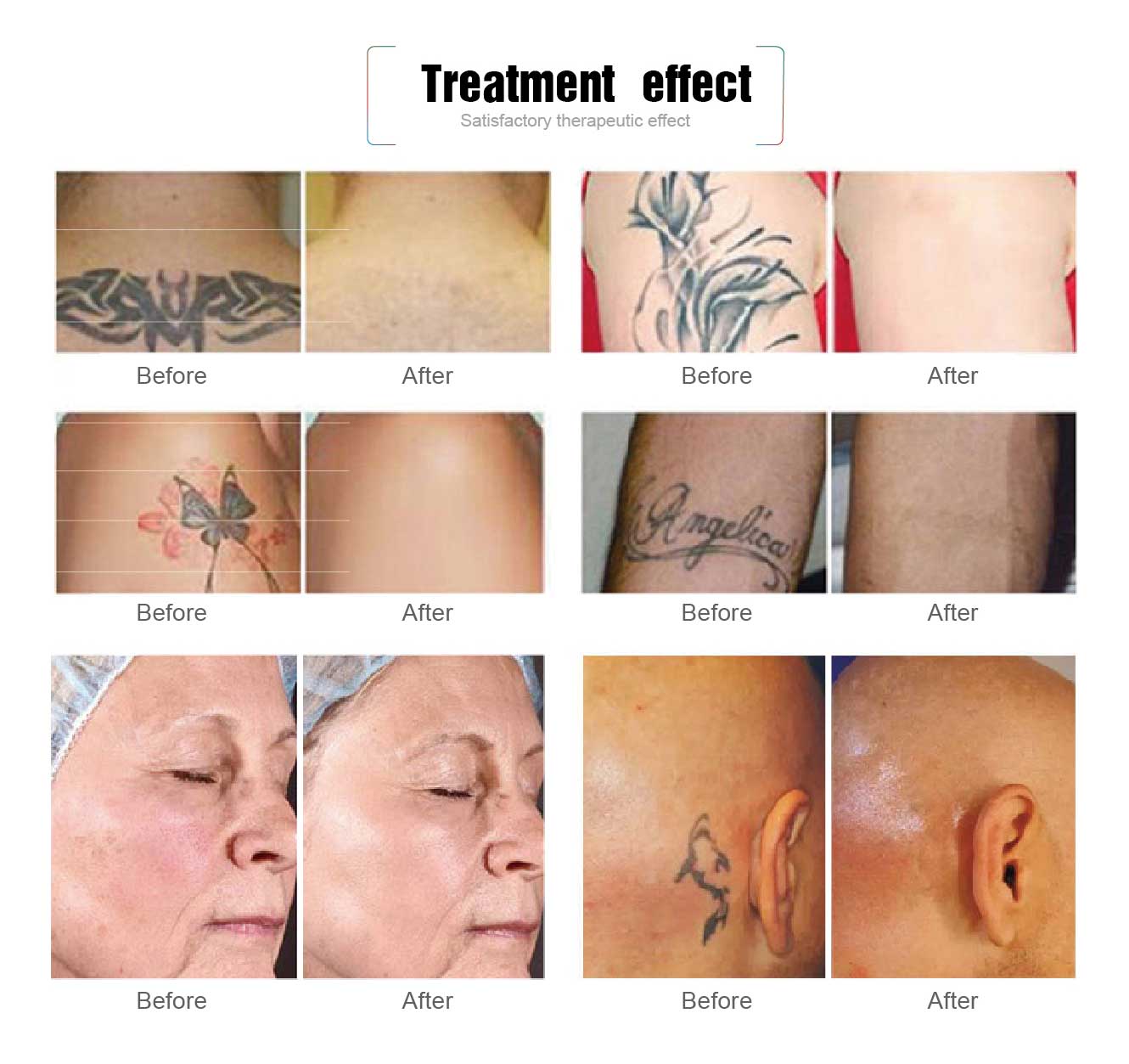before and after for picosecond laser