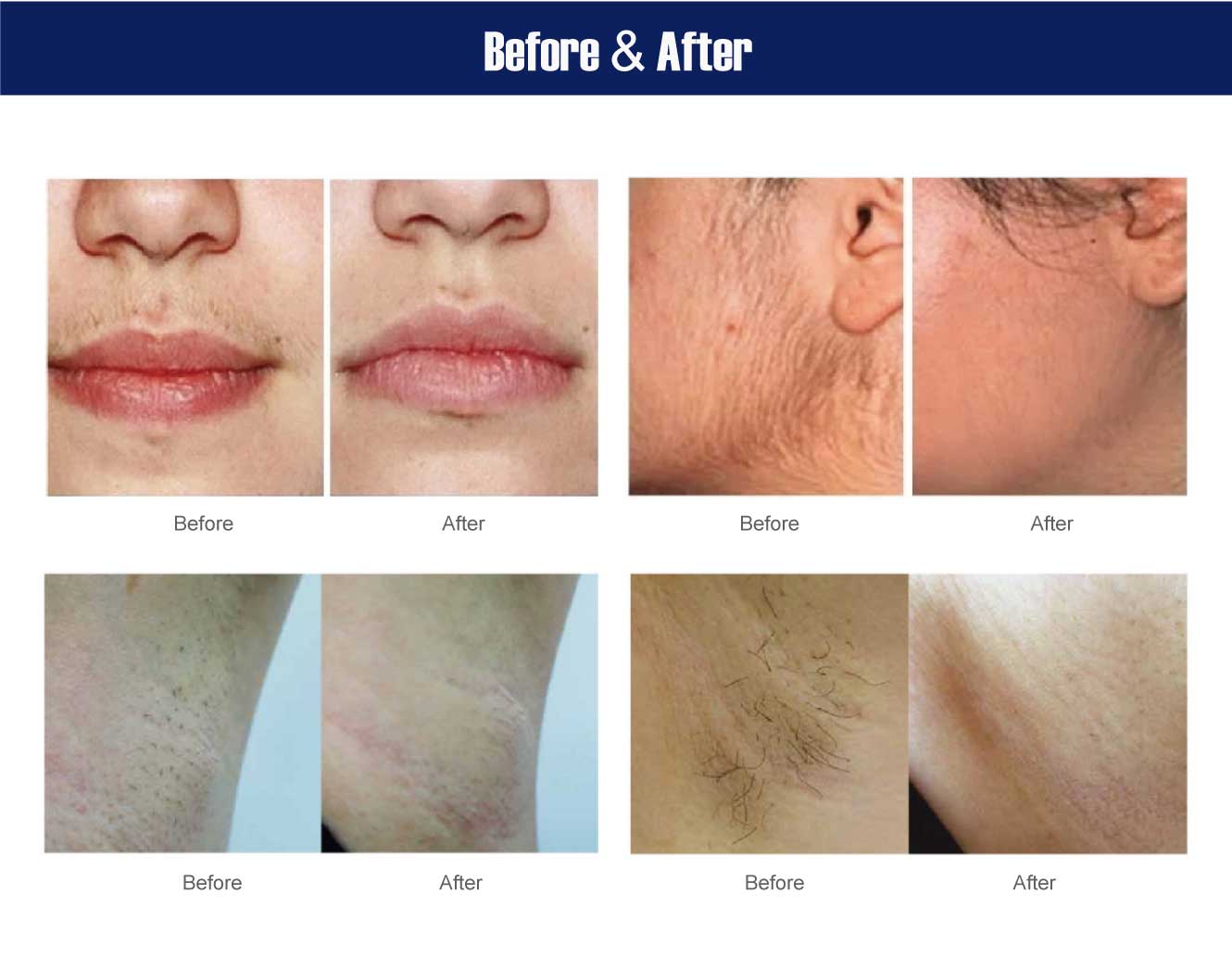 best diode laser hair removal machine