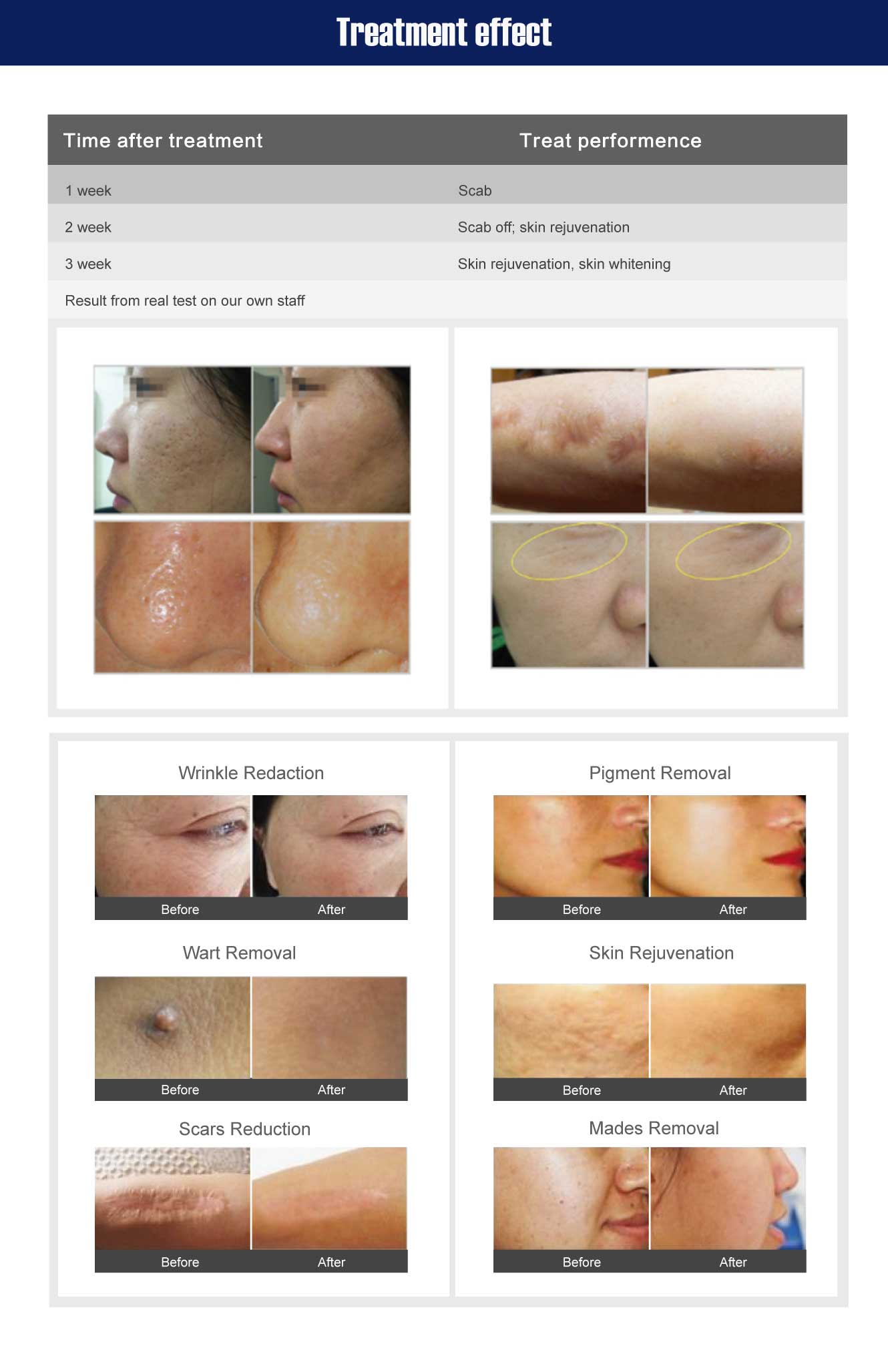  co2 laser treatment machine