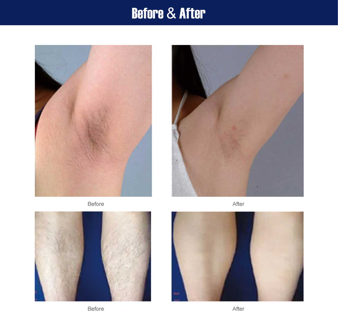 diode laser hair removal equipment