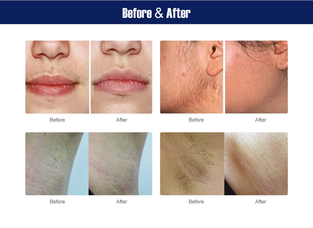 diode laser hair removal machine 808nm