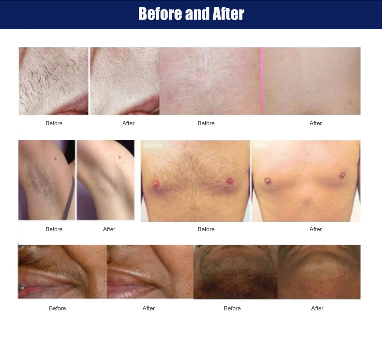 diode laser hair removal treatment
