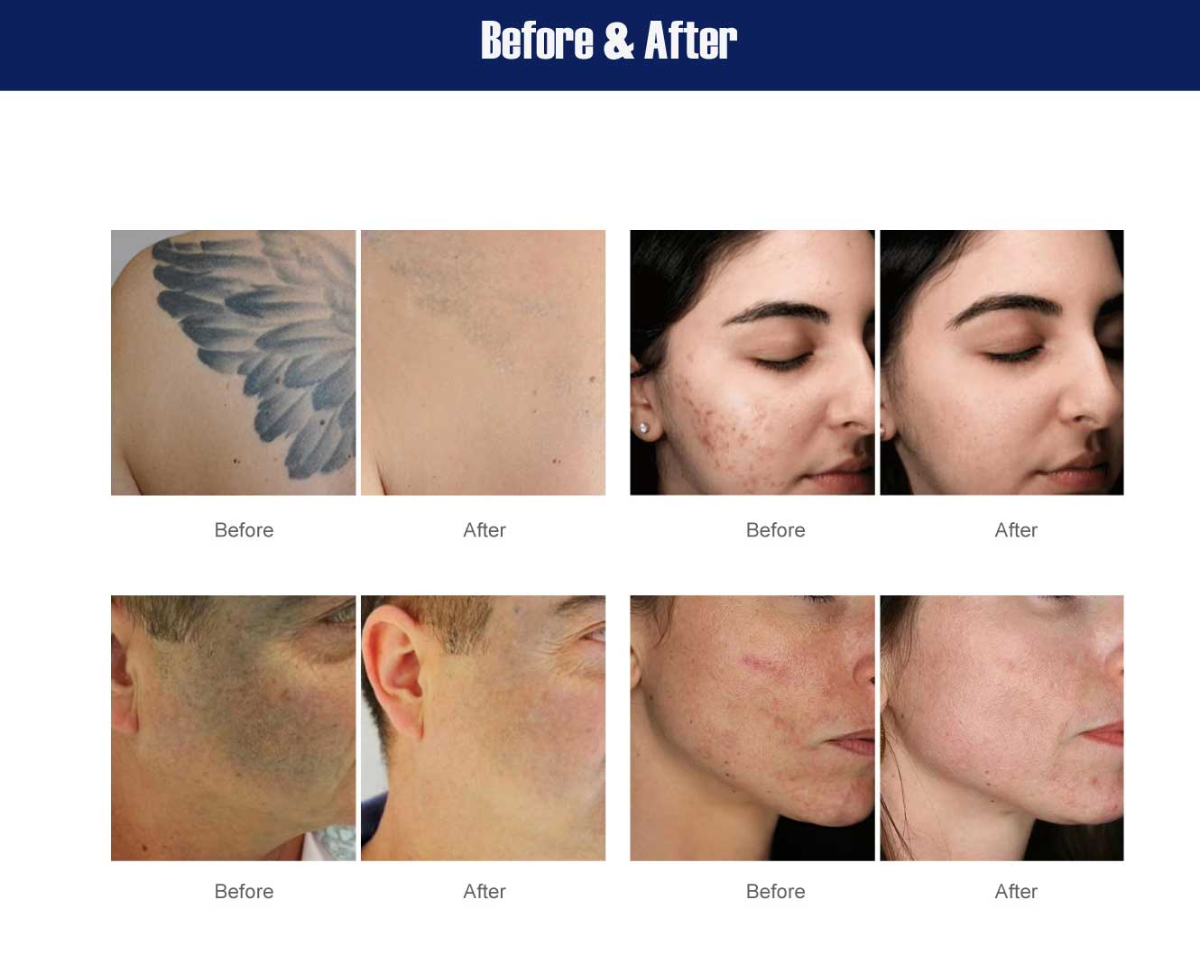 picosecond tattoo removal machine