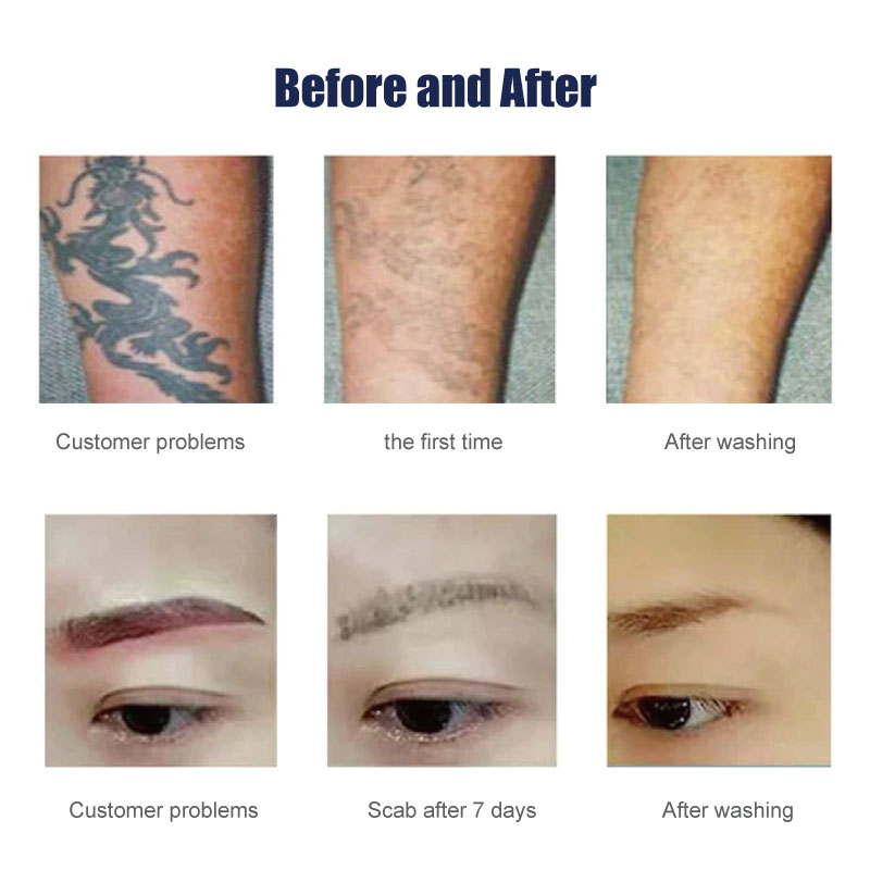 q switch nd yag laser tattoo removal machine