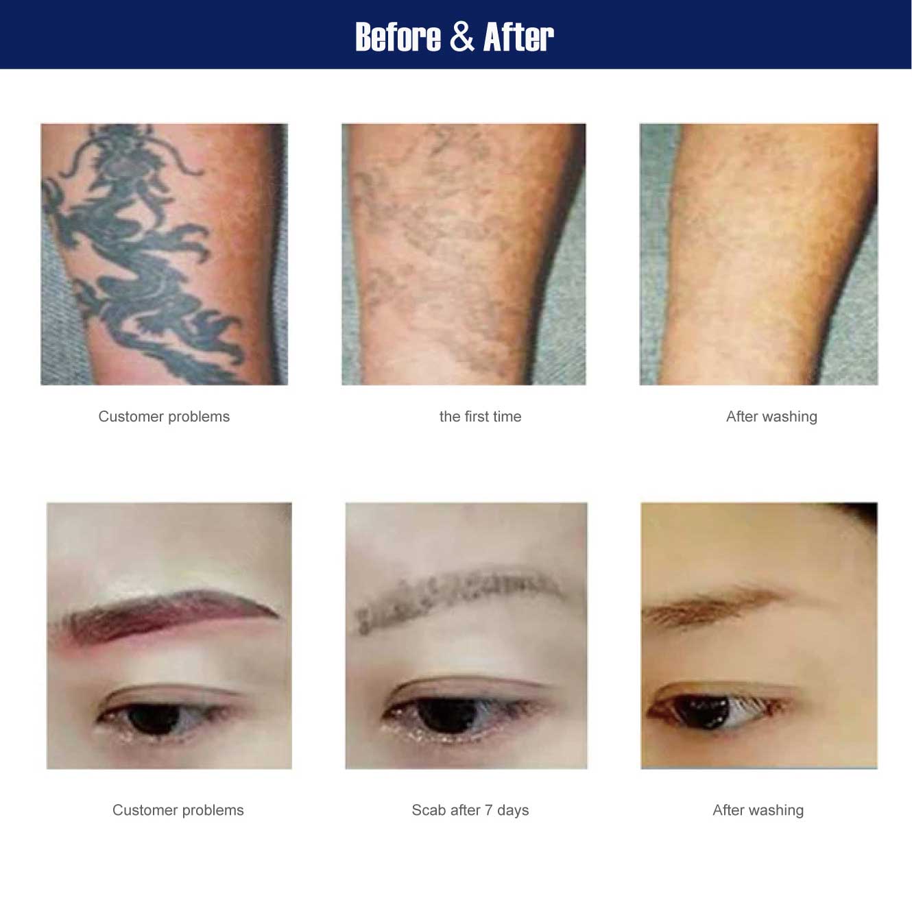 q switch nd yag laser tattoo removal machine