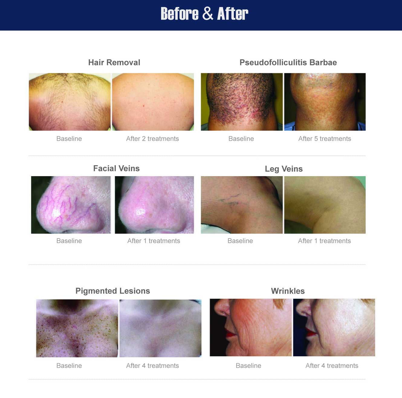 best laser hair removal machine alexandrite