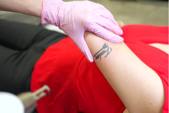 How Does a Picosecond Laser Machine Treat Tattoos