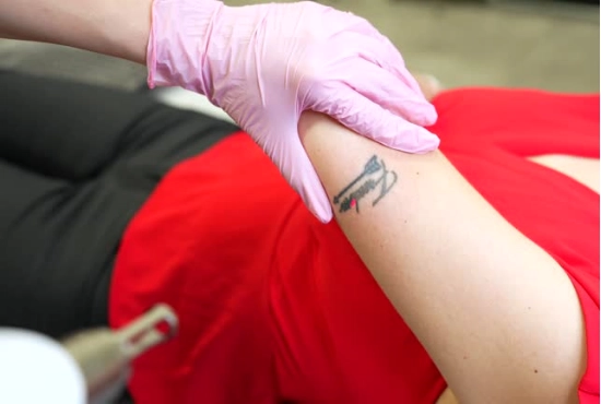 tattoo removal